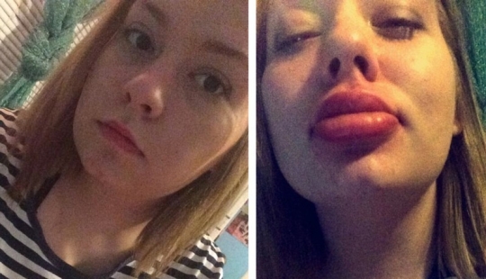 Girls try to make their lips plump like a TV star. It doesn&#39;t turn out very...