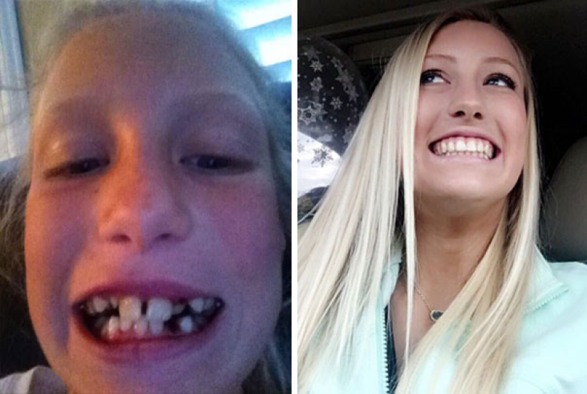 Here's how radically braces change a smile and life