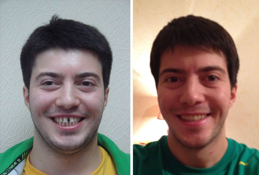 Here's how radically braces change a smile and life