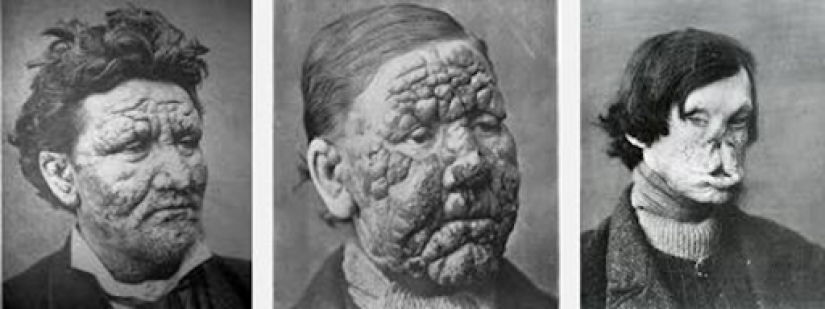 Historia de la lepra: ¿por qué la humanidad ha conquistado, pero no derrotado "perezoso de la muerte"