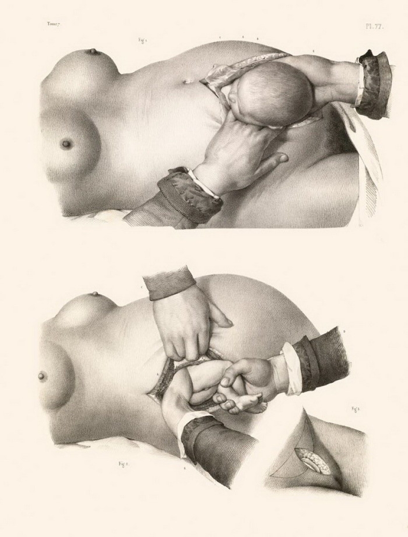 How were surgeries done at the beginning of the last century