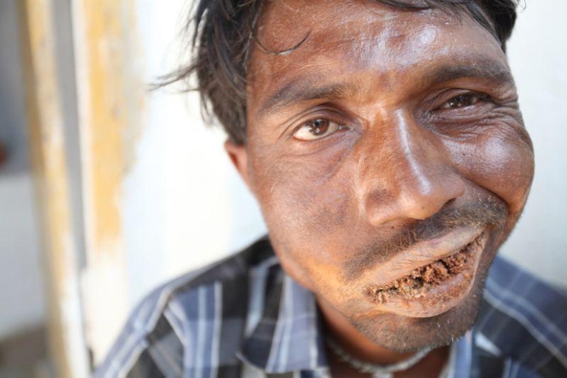 Indian man eats bricks and stones for 20 years