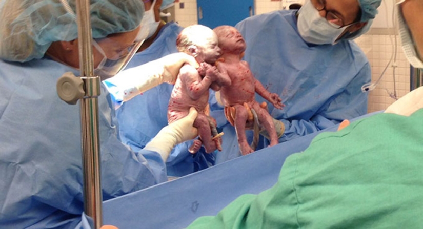 Inseparable twins holding each other's hand at birth, two years later