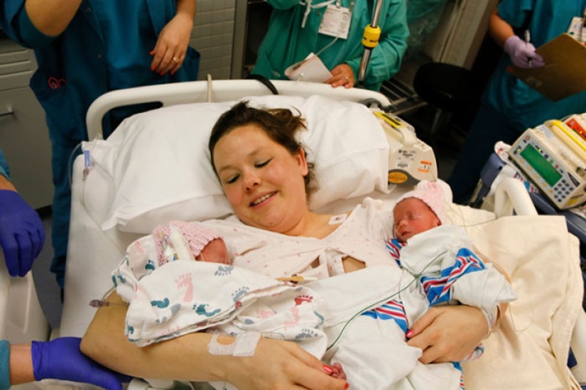 Inseparable twins holding each other's hand at birth, two years later
