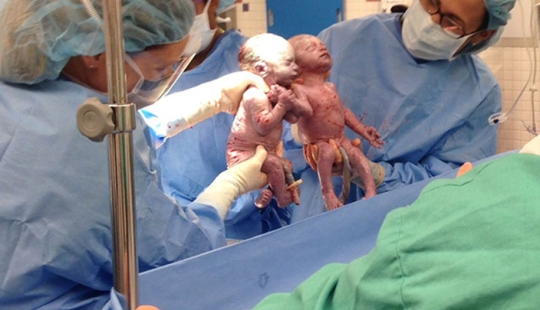 Inseparable twins holding each other's hand at birth, two years later