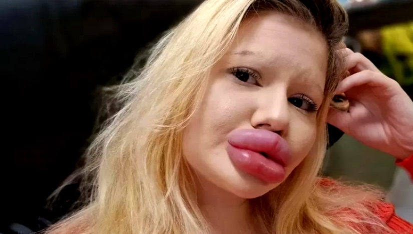 La chica con los labios más grandes del mundo decidió agrandar sus pómulos