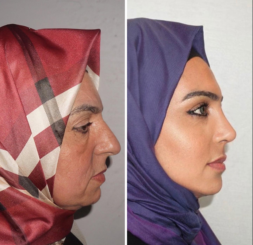 Las fotos de antes y después de la clínica turca de cirugía plástica han dejado a la gente desconcertada