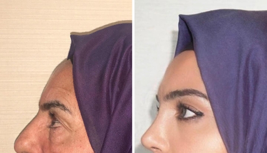 Las fotos de antes y después de la clínica turca de cirugía plástica han dejado a la gente desconcertada
