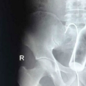 Los objetos más espeluznantes que se han encontrado en un estómago humano