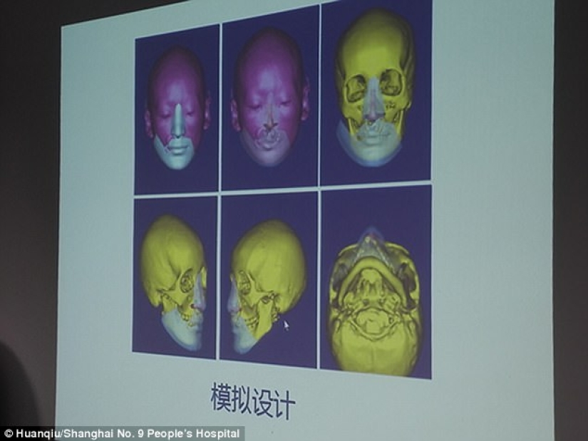 Mujer china con cara deformada los médicos le hacen crecer una nueva cara en el pecho