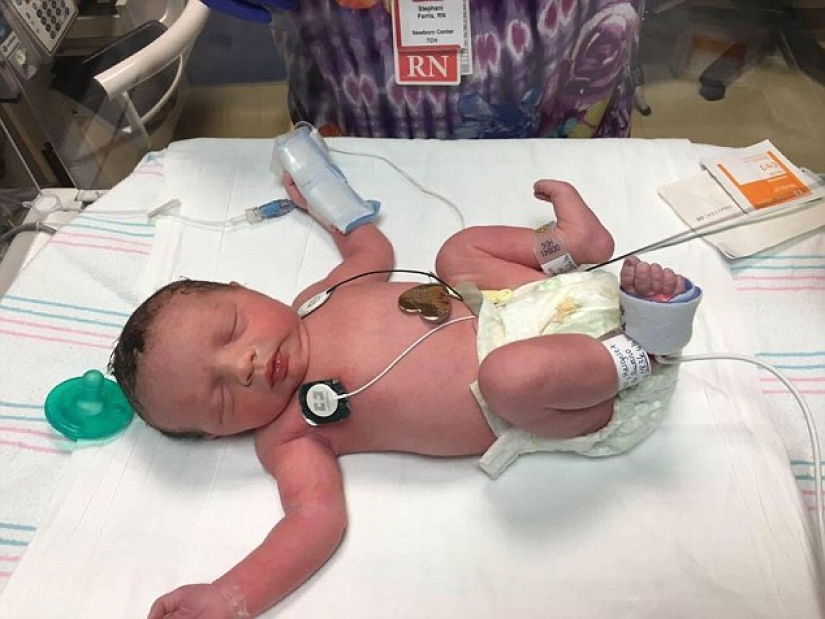 Nacido dos veces: los médicos sacaron al bebé del útero para operarlo y traerlo de vuelta