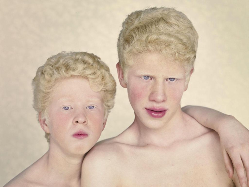 No como todos los demás: personas albinas