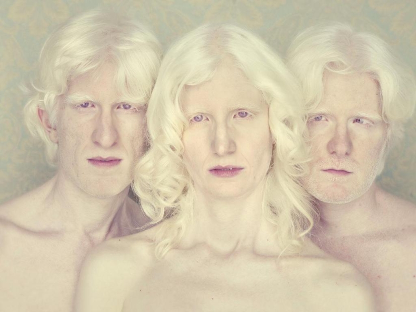 No como todos los demás: personas albinas