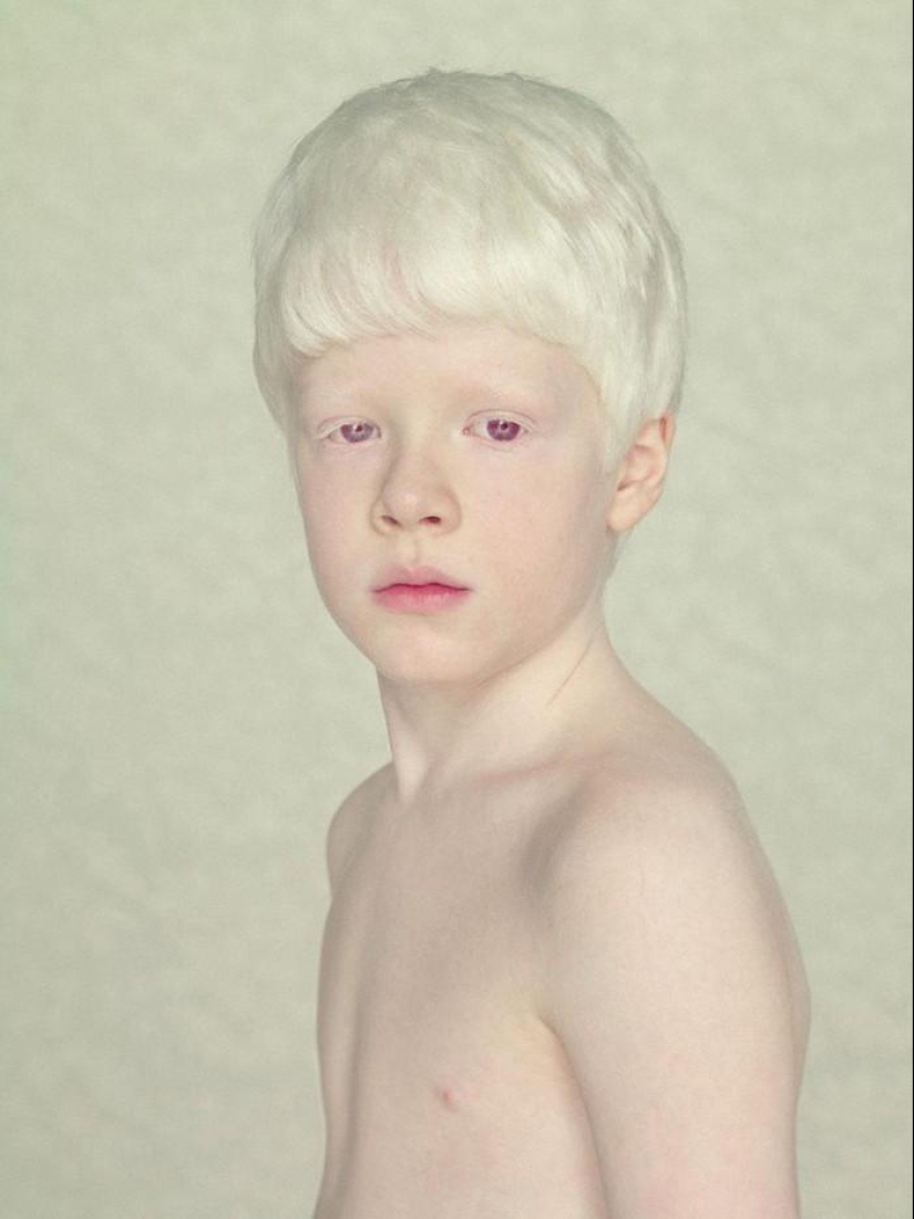 Not like everyone else: albino people
