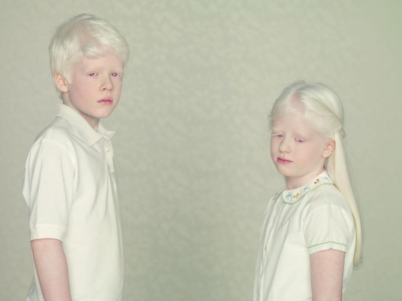 Not like everyone else: albino people