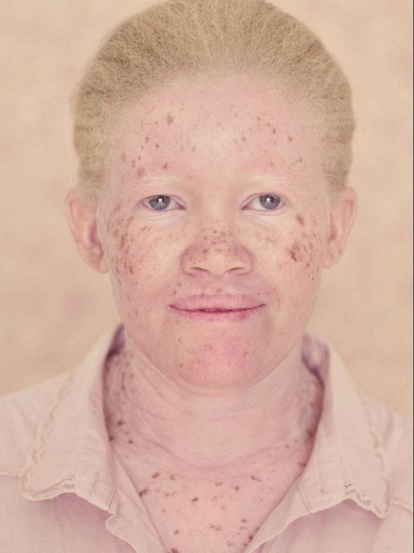 Not like everyone else: albino people