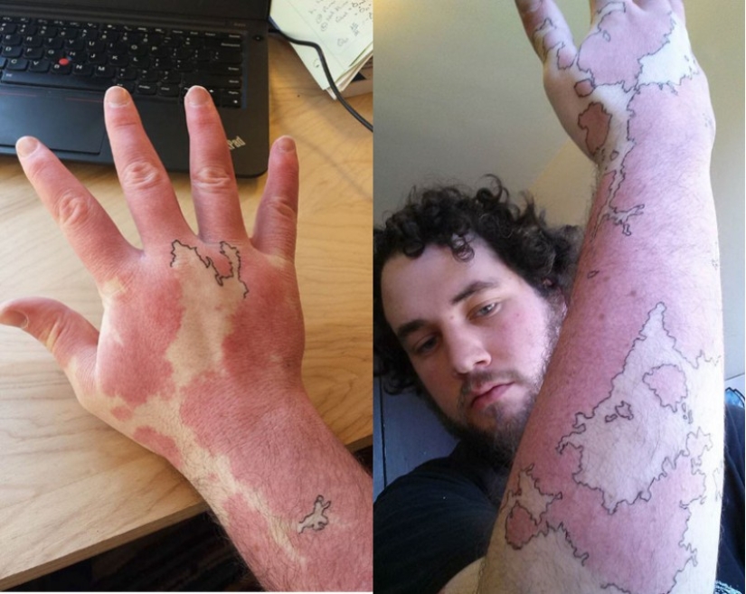 People with birthmarks who did not get confused and made them part of tattoos