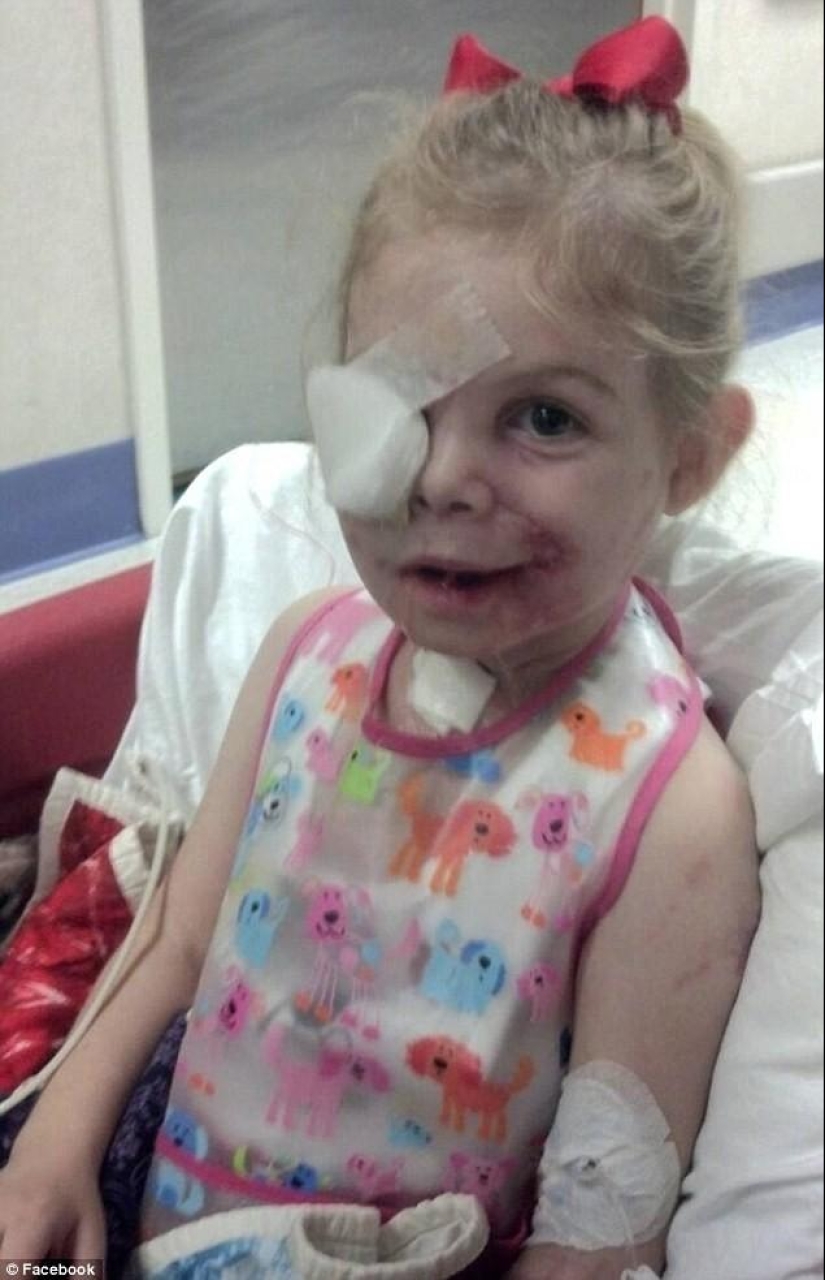 Pit bull mutilated 3-year-old girl kicked out of diner because of her appearance