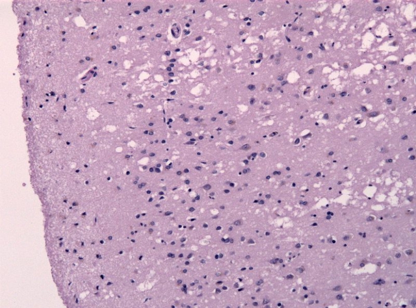 Prion diseases, which slowly and painfully die in 100% of cases