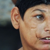 "Ratas de Shah Daula": niños de Pakistán con cráneos deformes y un destino duro
