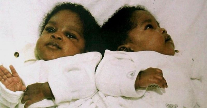 Siamese twins separated in infancy continue to sleep the same way as before the operation