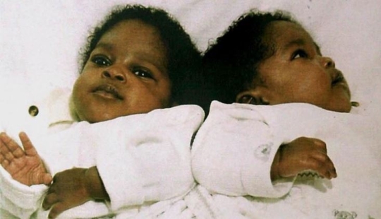 Siamese twins separated in infancy continue to sleep the same way as before the operation