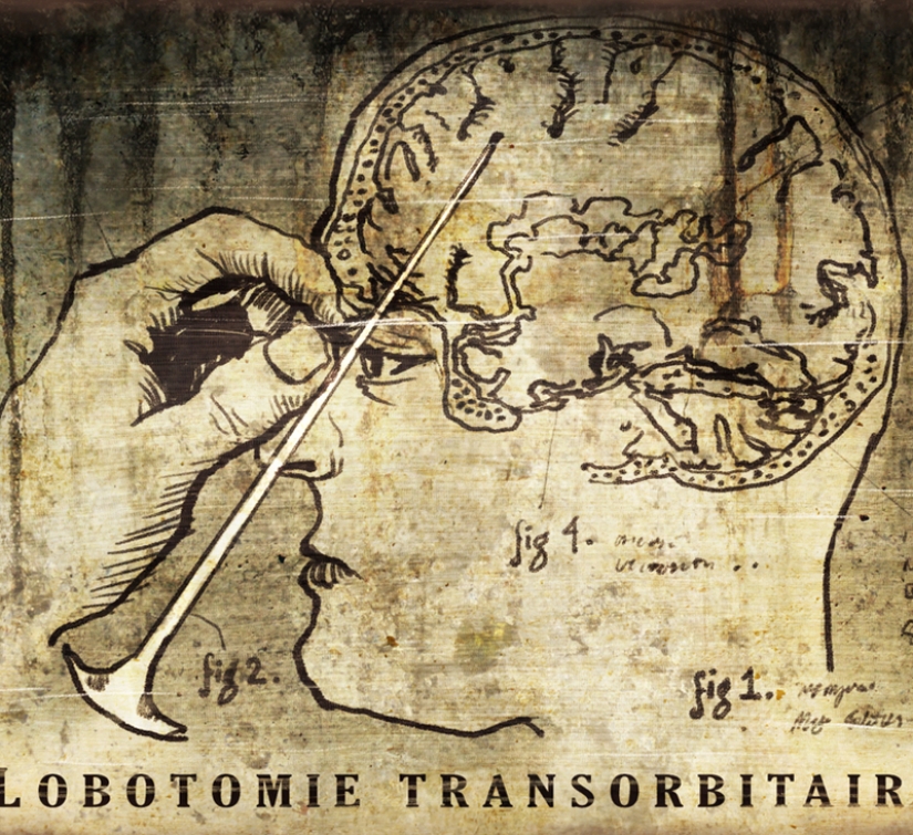Terrible "medicine" of quarrelsomeness and nymphomania: Top 10 frightening facts about lobotomies
