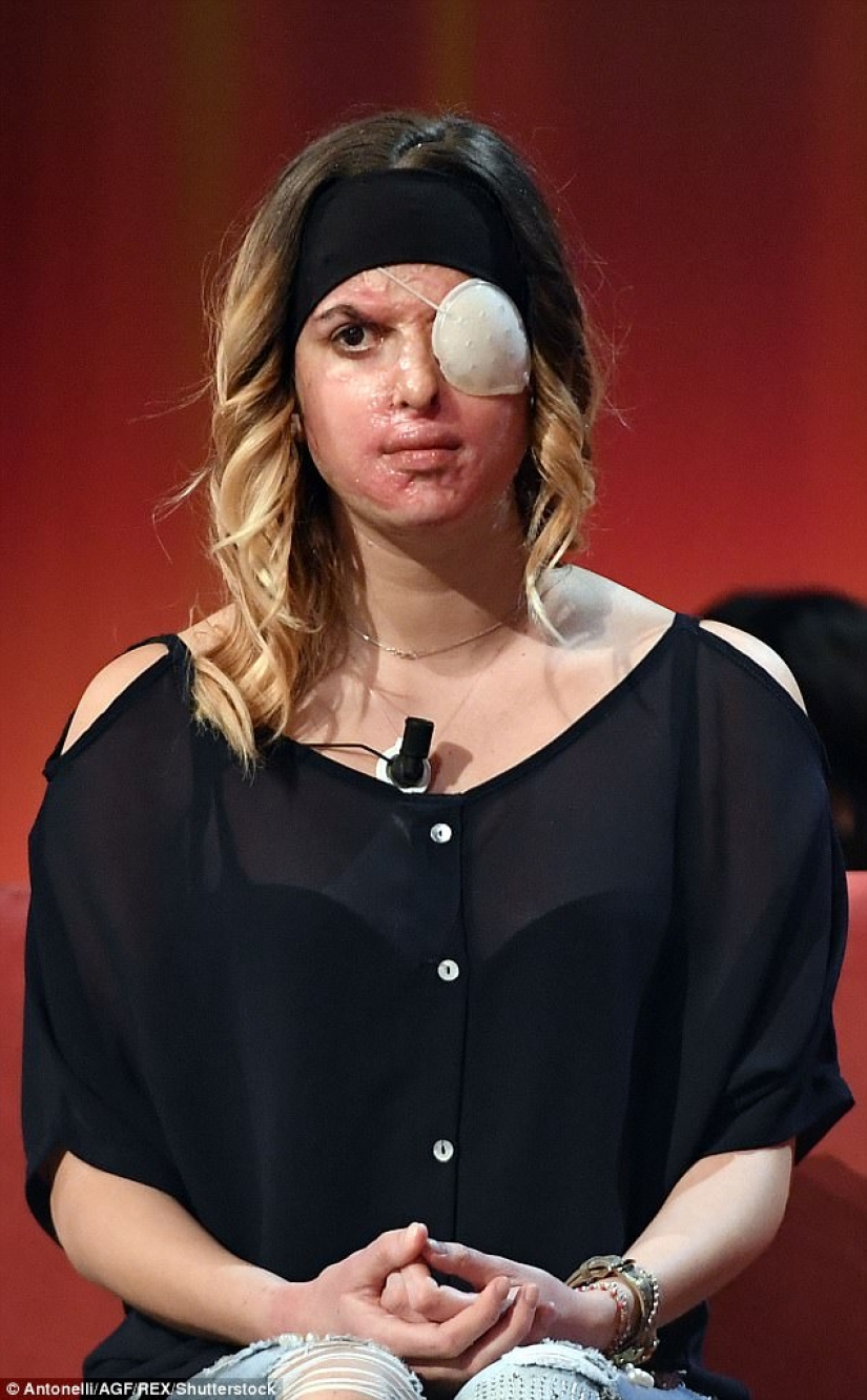 The beauty queen, who was doused with acid by her ex-fiance, showed a disfigured face