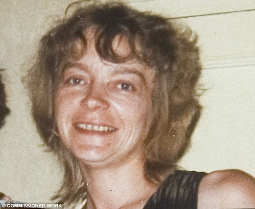 The first woman with a transplanted face died of cancer caused by anti-rejection drugs