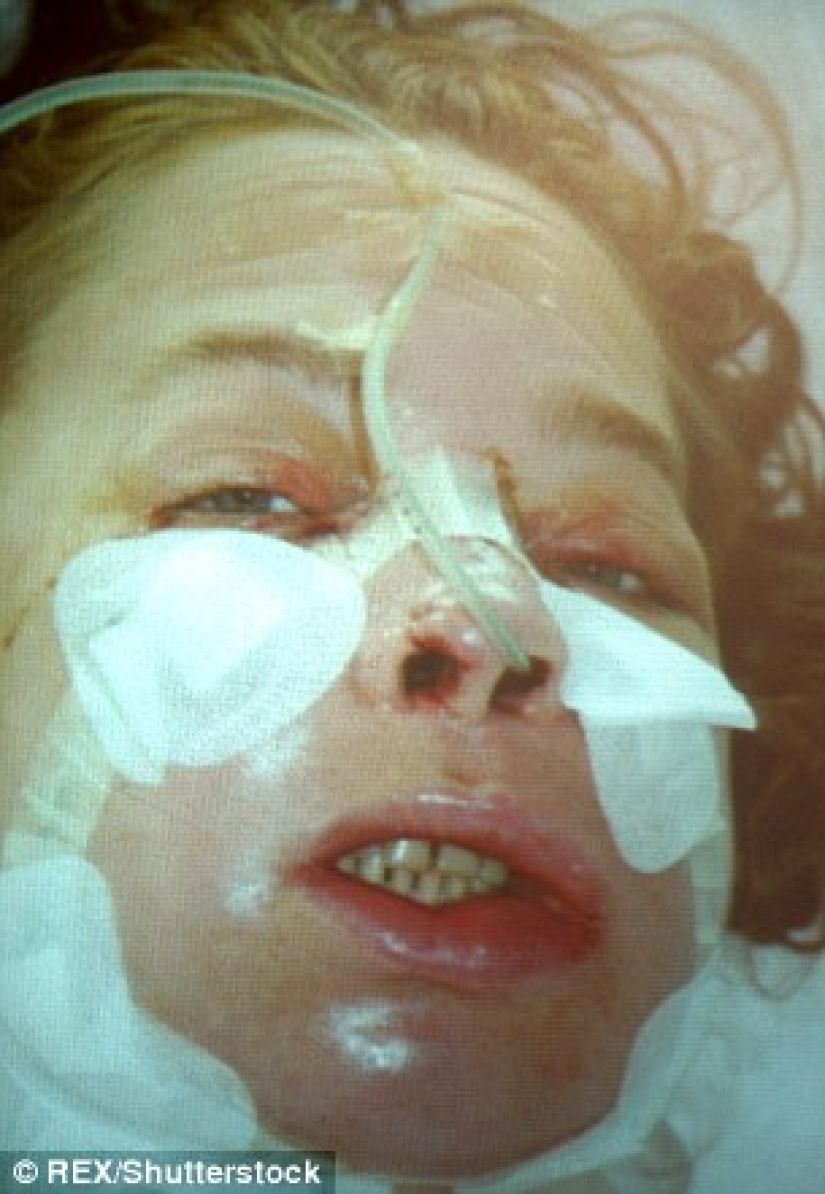 The first woman with a transplanted face died of cancer caused by anti-rejection drugs