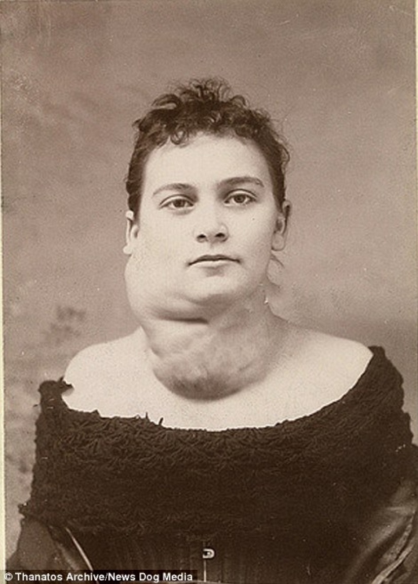 The harsh XIX century: a collection of archival photographs of people with deformities