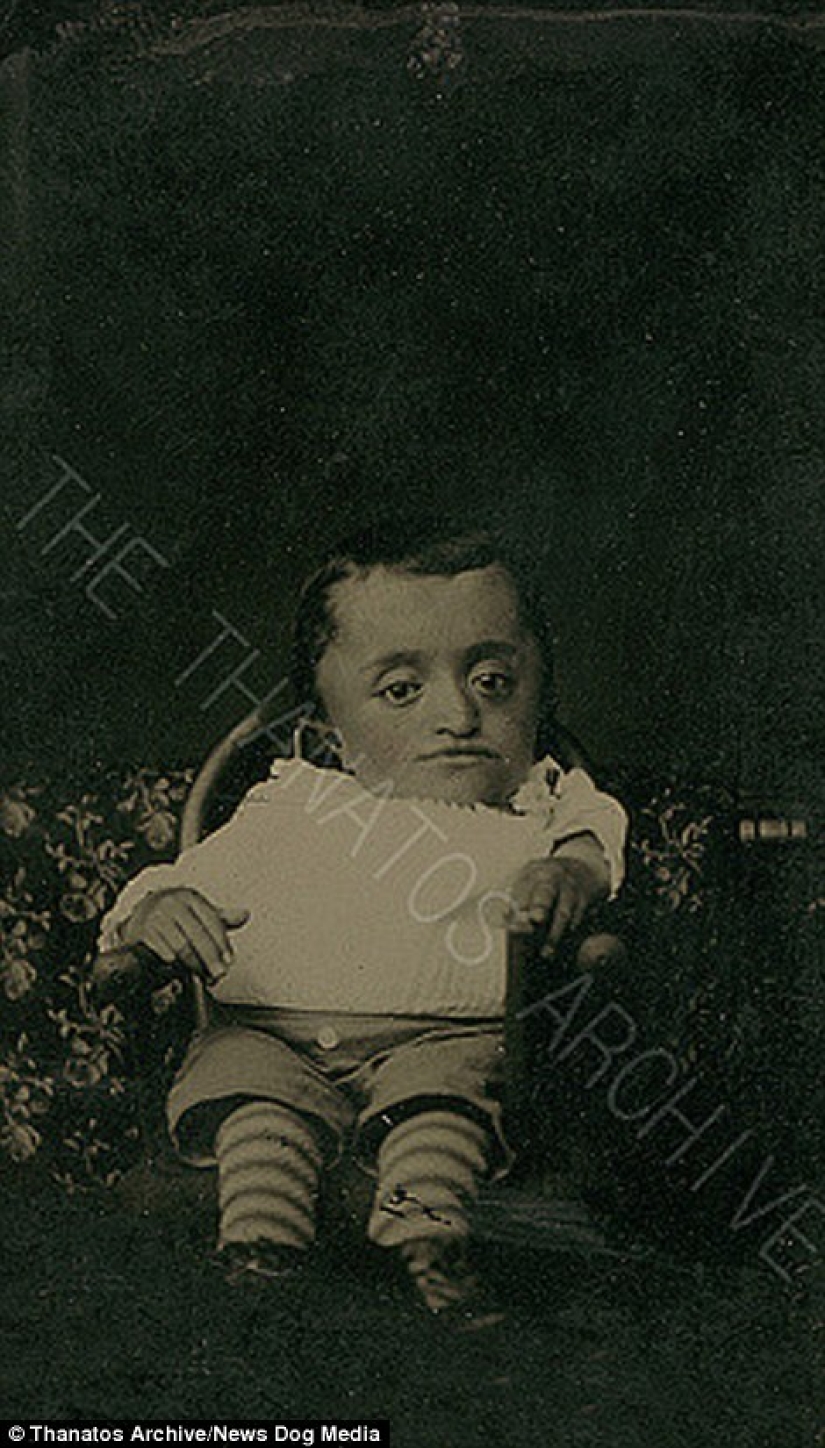 The harsh XIX century: a collection of archival photographs of people with deformities