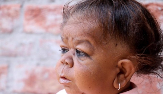 The inexplicable story of a 21-year-old Indian who got stuck in the body of a baby