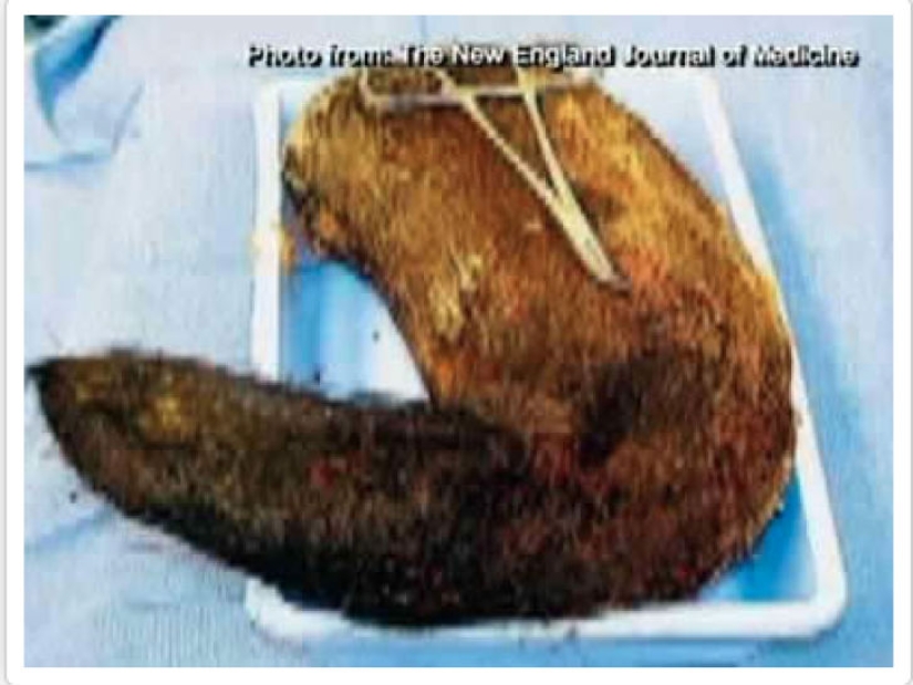 The most creepy objects that have ever been found in a human stomach