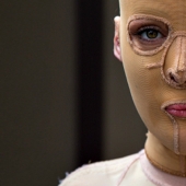 The once almost burned alive Australian woman finally took off her mask