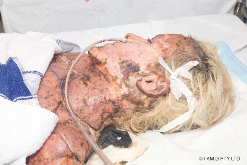 The once almost burned alive Australian woman finally took off her mask