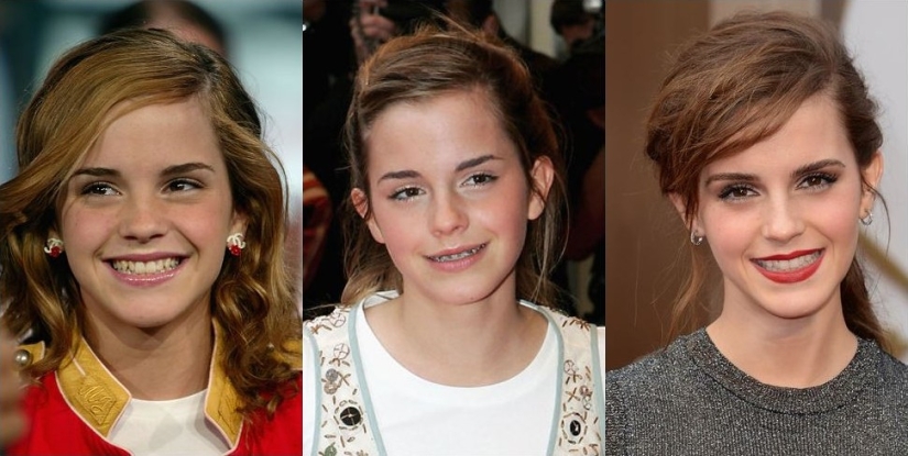 These celebrities will show you how braces can dramatically change your smile