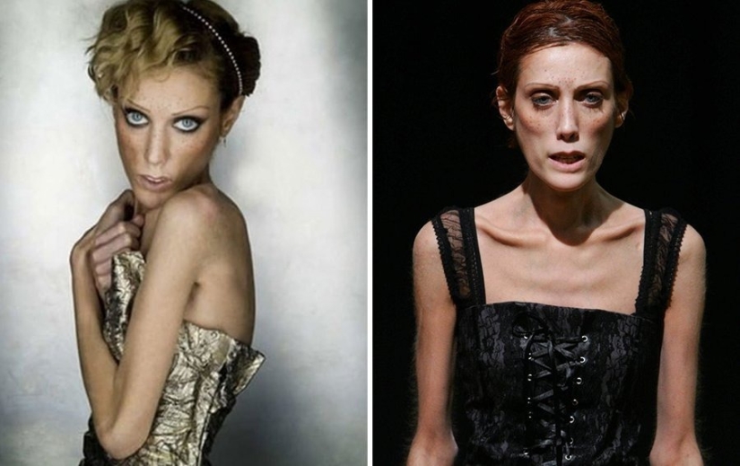 They were afraid to get fat: 9 stars who were ruined by anorexia