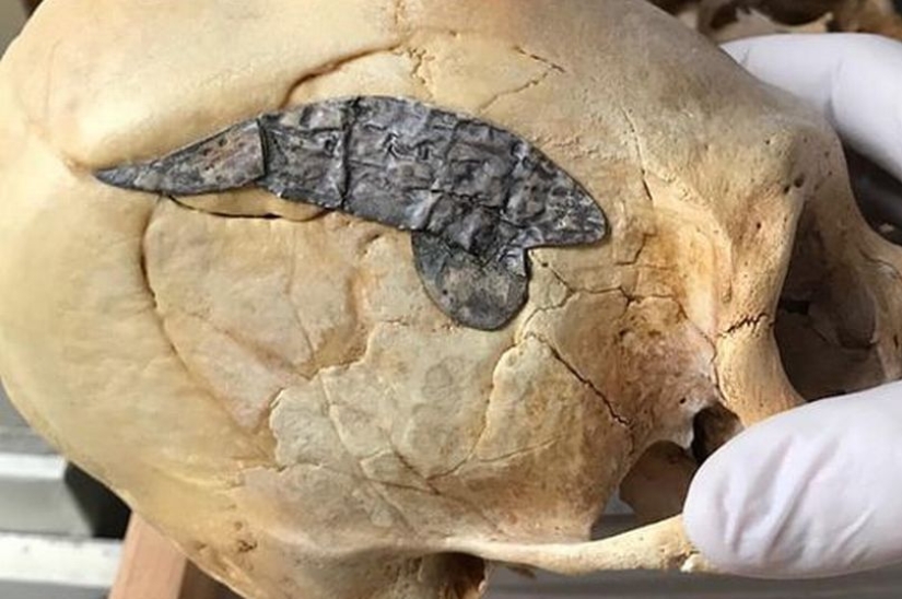 Un cráneo humano unido con metal hace 2000 años sorprendió a los científicos