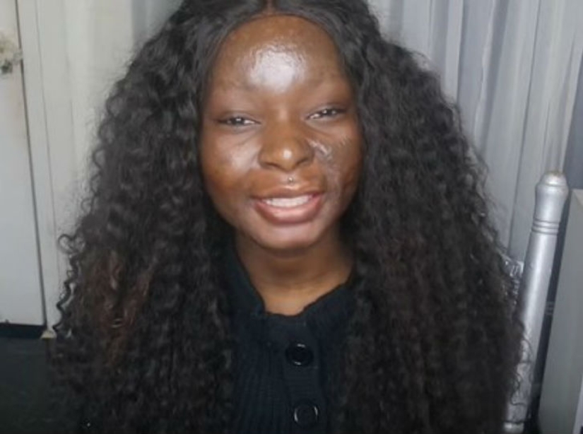 Una niña con graves quemaduras faciales demuestra el poder del maquillaje