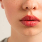 We remove a sad, dissatisfied face along with nasolabial wrinkles and increase the volume of the lips