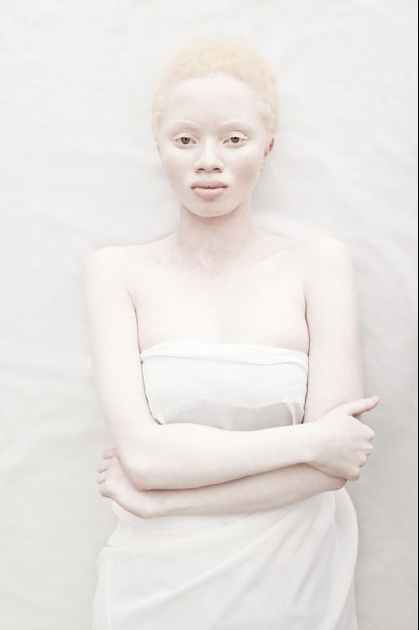 What do albinos of different nationalities and races look like