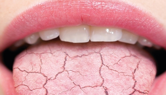 Where are the cracks on the tongue from and how dangerous is it?