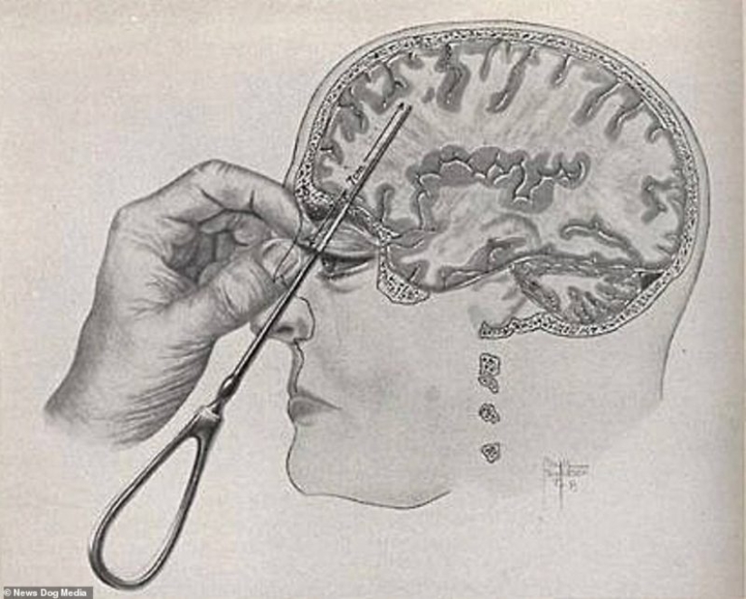 Without the past and the future: treatment of lobotomy from mental disorders