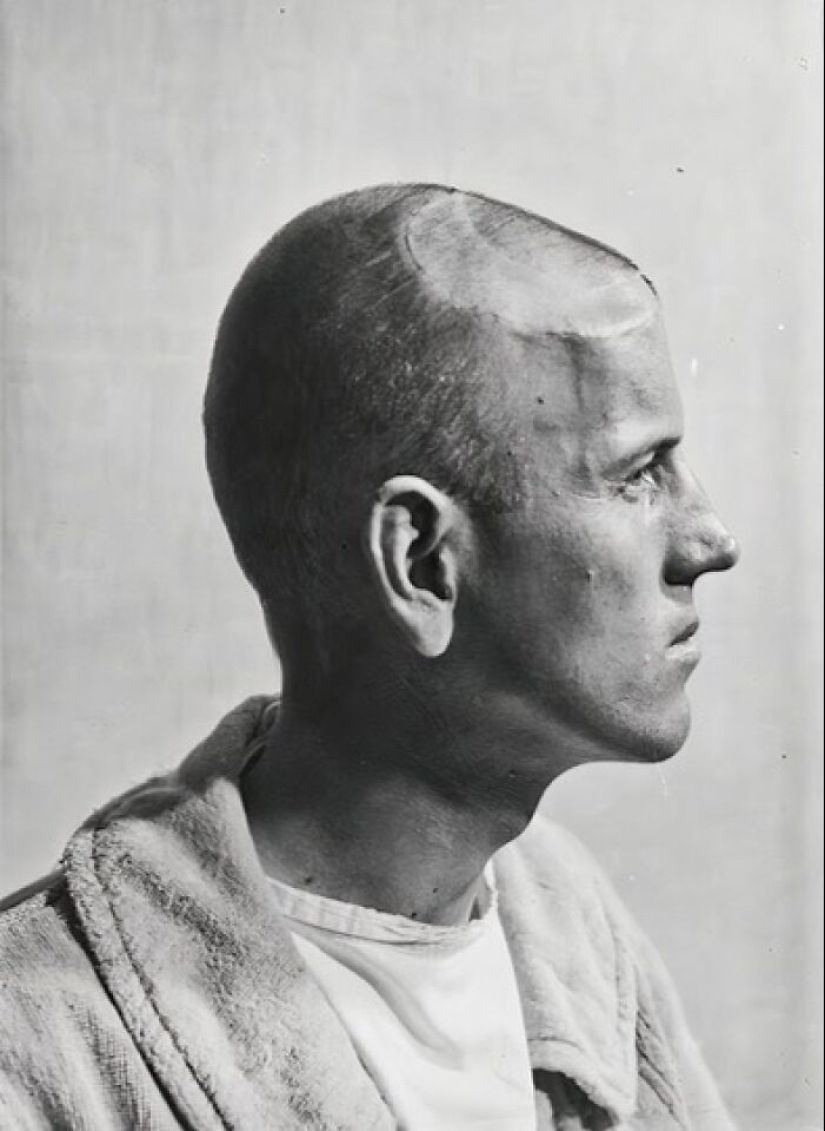 11 inquietantes retratos médicos de los pacientes de Harvey Cushing a principios del siglo XX