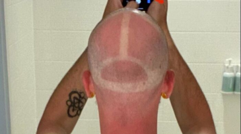 15 People Who Thought They Didn’t Need Sunscreen And Ended Up Looking Like Dorks