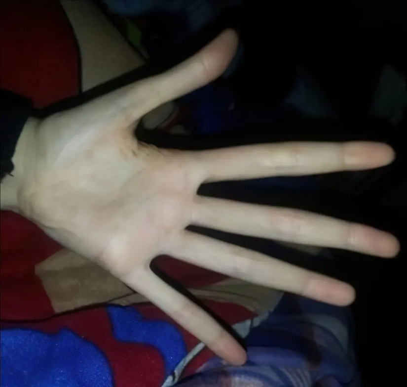 17 rare anomalies of human hands