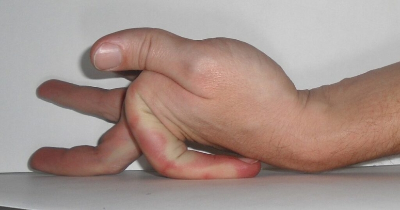 17 rare anomalies of human hands