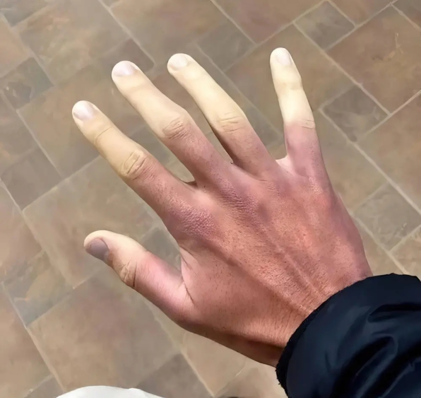 17 rare anomalies of human hands