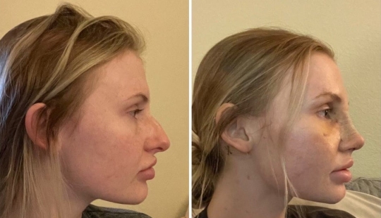 22 photos of people who went under the surgeon's knife and never regretted it